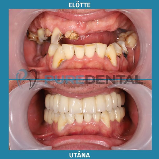 Fogimplantátum eredmények