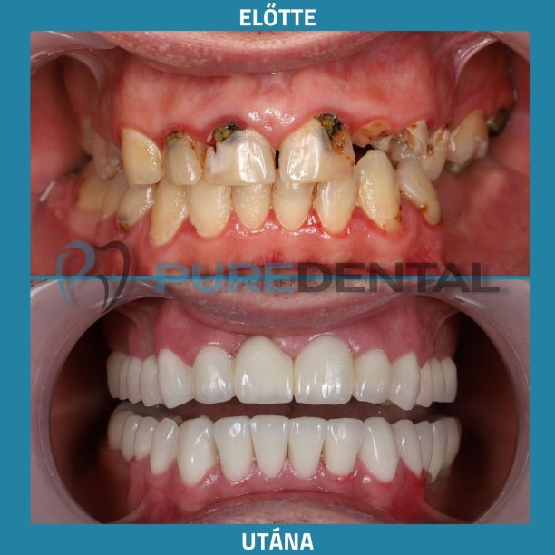 Fogimplantátum eredmények